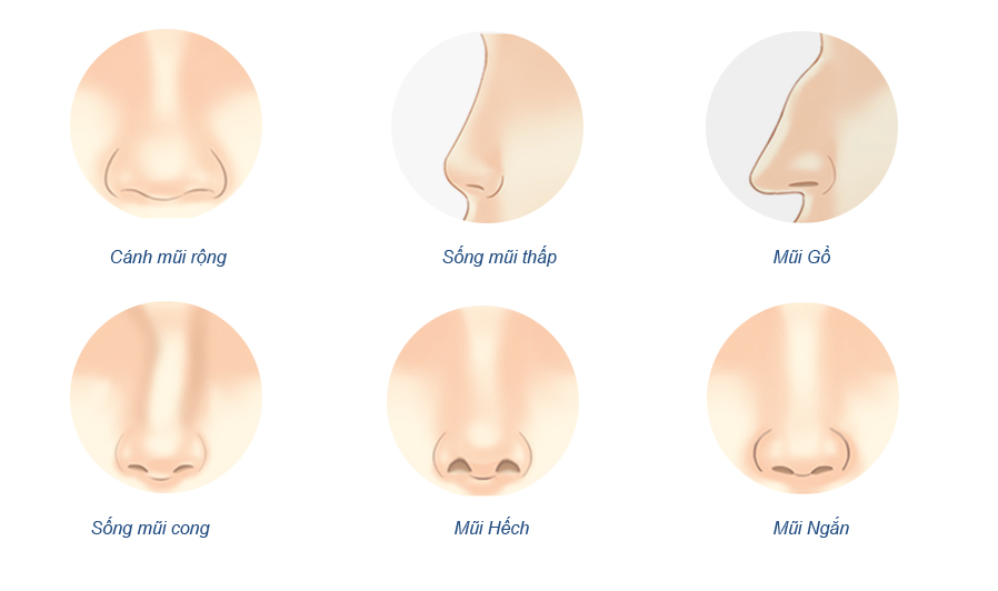 Nâng mũi cấu trúc - Chỉnh sửa cấu trúc mũi toàn diện - Mũi đẹp tự nhiên