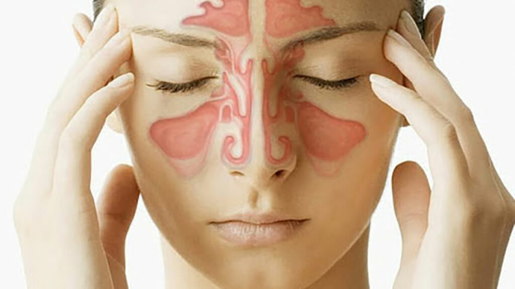 Những người bị viêm xoang vẫn có thể tiến hành nâng mũi bình thường