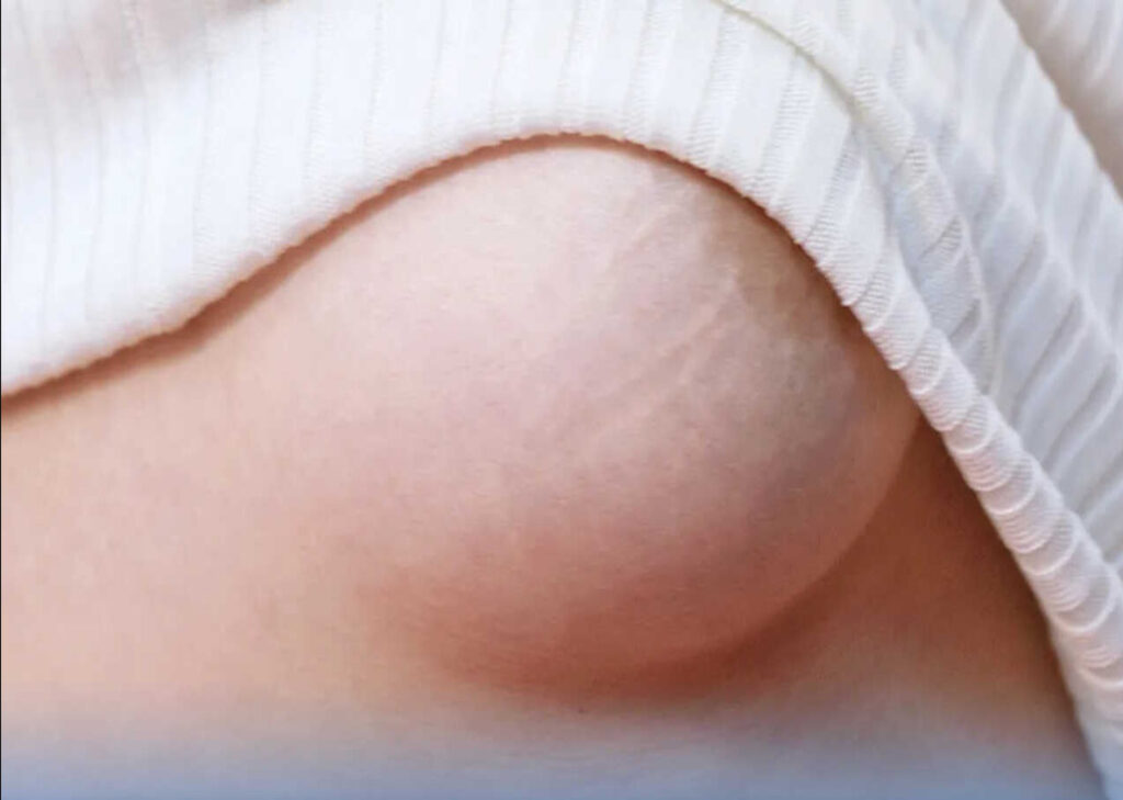 Nâng ngực có gây rạn da không?